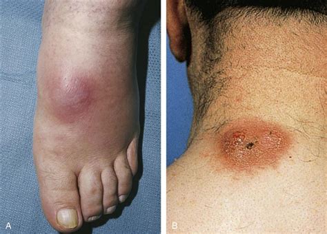 cellulitis icd-10|icd 10 cellulitis right foot.